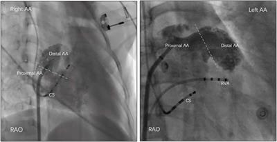 Treatment Strategy in Atrial Tachycardia Originating From the Atrial Appendage